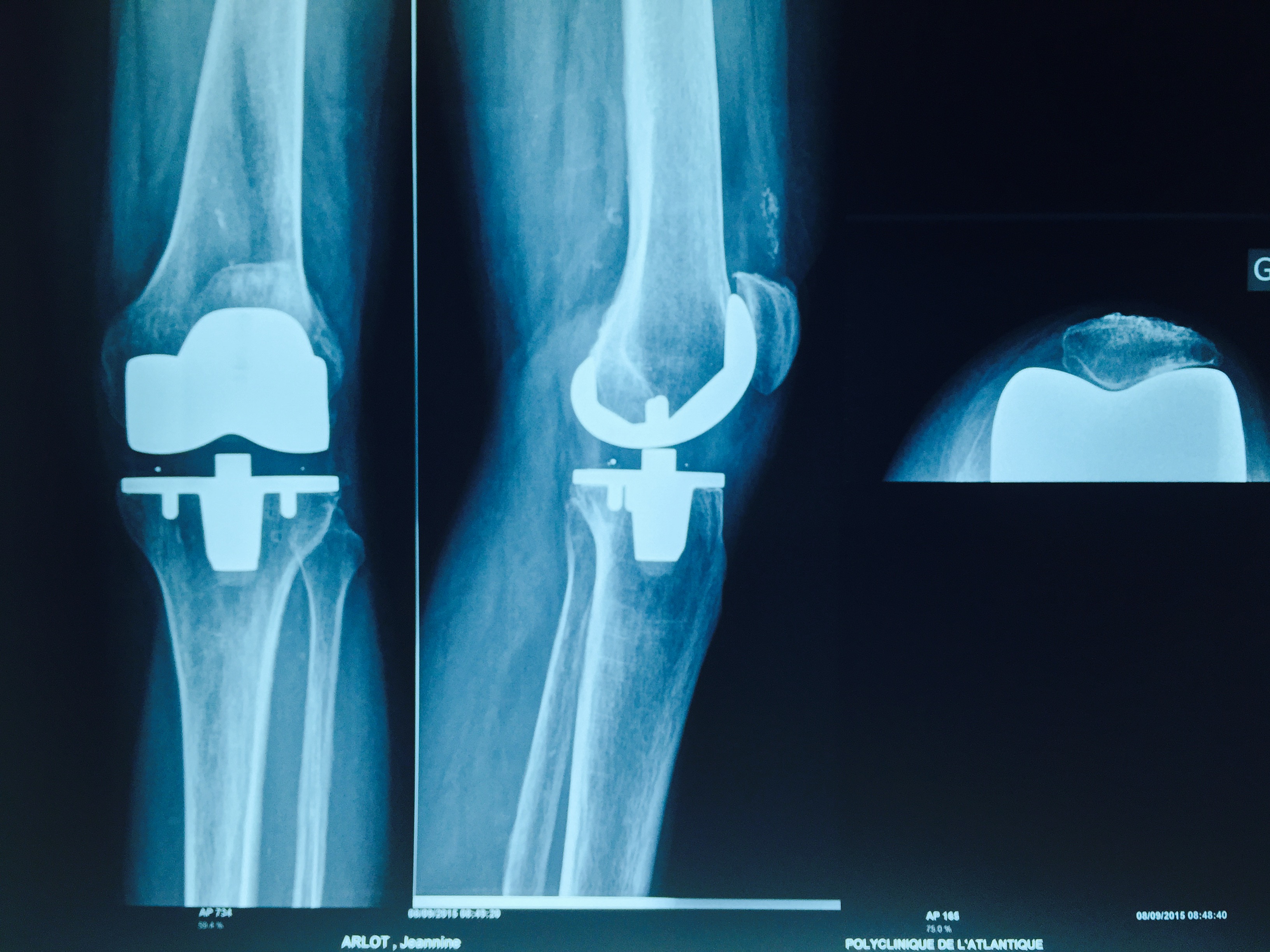 LA PROTHESE DU GENOU - Institut Chirurgie Orthopédique Nantes Atlantique